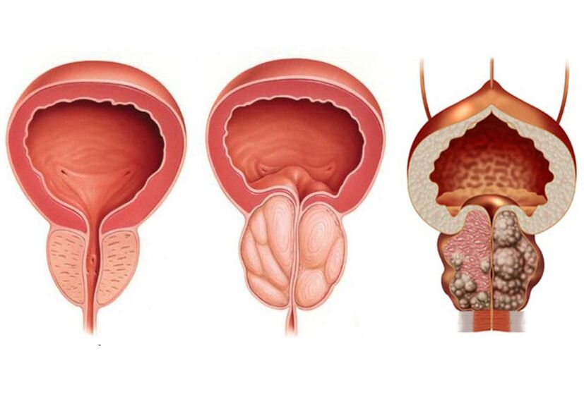 Prostatitis faseak eta prostavit guztiz erabiltzeko beharra
