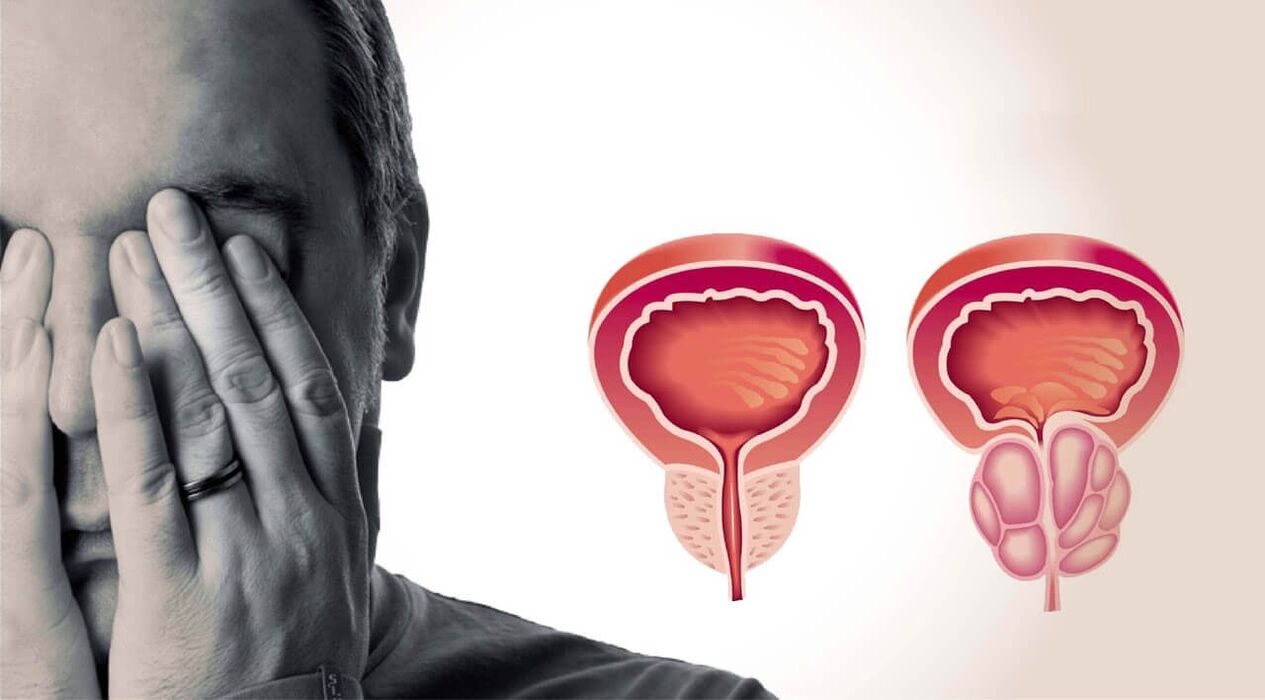 Prostata osasuntsua eta mina gizonezkoetan